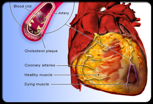 infarct open-uri20120815-14072-1j7ph4p